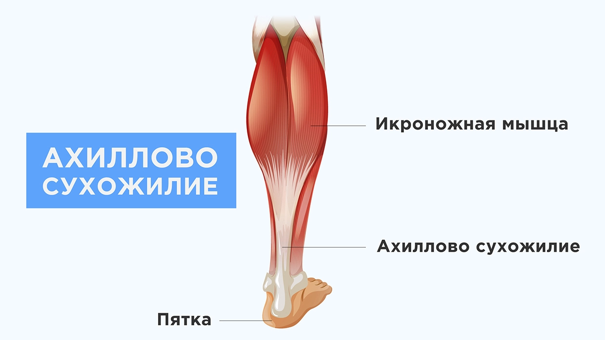 Повреждение ахиллова сухожилия - симптомы, причины, диагностика и методы  лечения